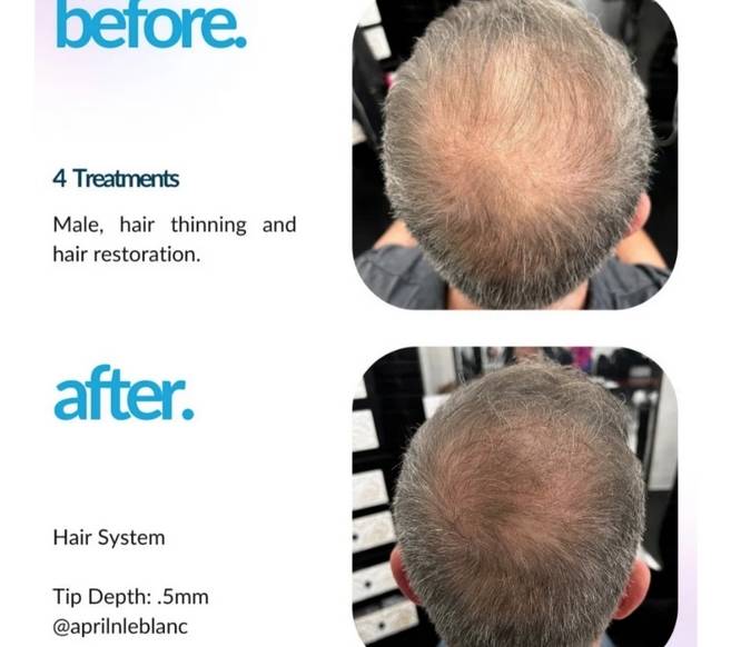 hair restoration in rockwall tx